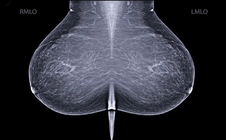 Mammograms of the left and right breast in black and white.