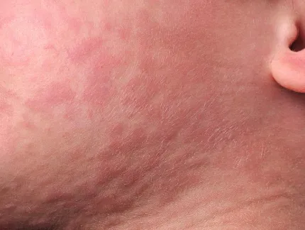 Strawberry allergy. What does a strawberry rash look like?