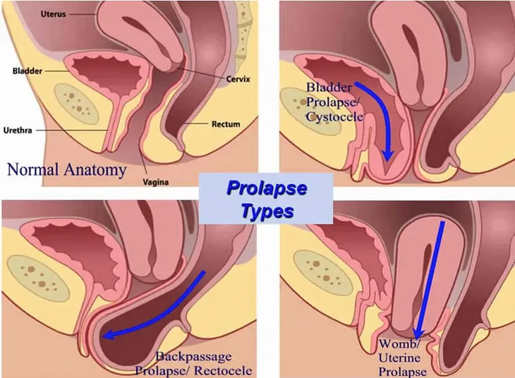 types of pelvic organ prolapse