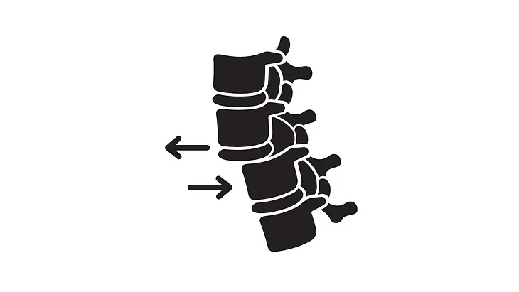 Is “spondylolisthesis” a real word?