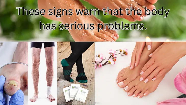 Women are most prone to nail fungus