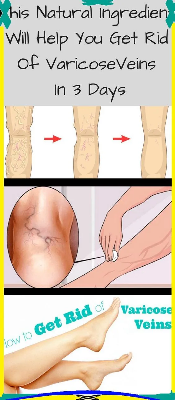 THIS NATURAL INGREDIENT WILL HELP YOU GET RID OF VARICOSE VEINS IN JUST 3 DAYS