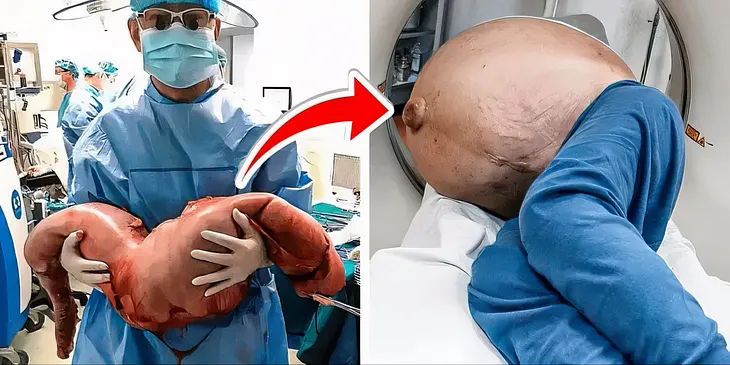 Shocked Doctors Remove 30 Pounds Of Poop Built Up For 22 Years.