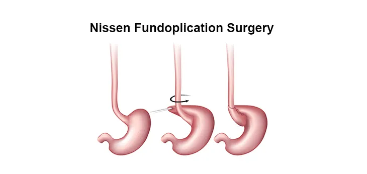 Precautions after a Nissen (laparoscopic) Fundoplication Surgery for GERD