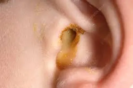 Cause and treatment for pus in my ear