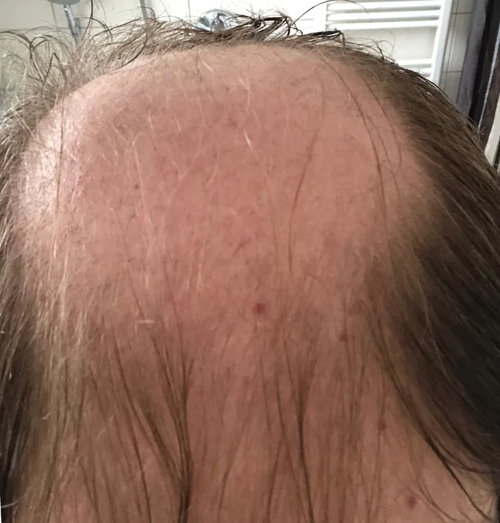 Hair loss treatment helpful or completely rubbish?