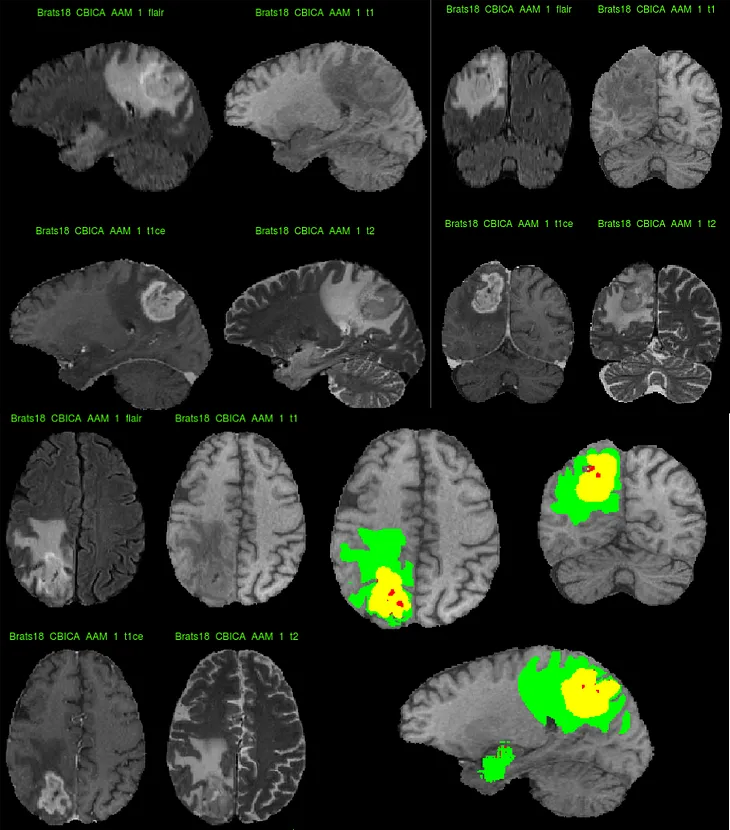 Intel AI for Non-Invasive Brain Cancer Research