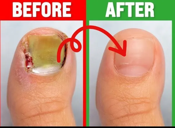 The most insightful stories about Toenail Fungus - Medium