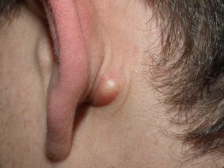 Sebaceous Cyst Ayurvedic Treatment: A Holistic Approach
