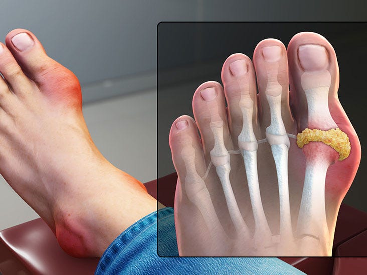What Causes Big Toe Joint Pain? Hill Regional Hospital Medium