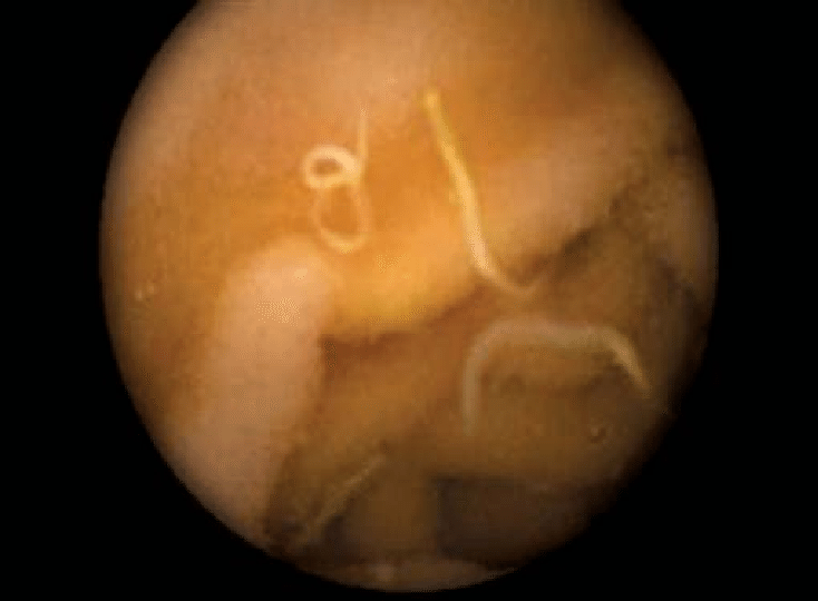 Hookworm and Complications. Hookworm is an intestinal parasite… by