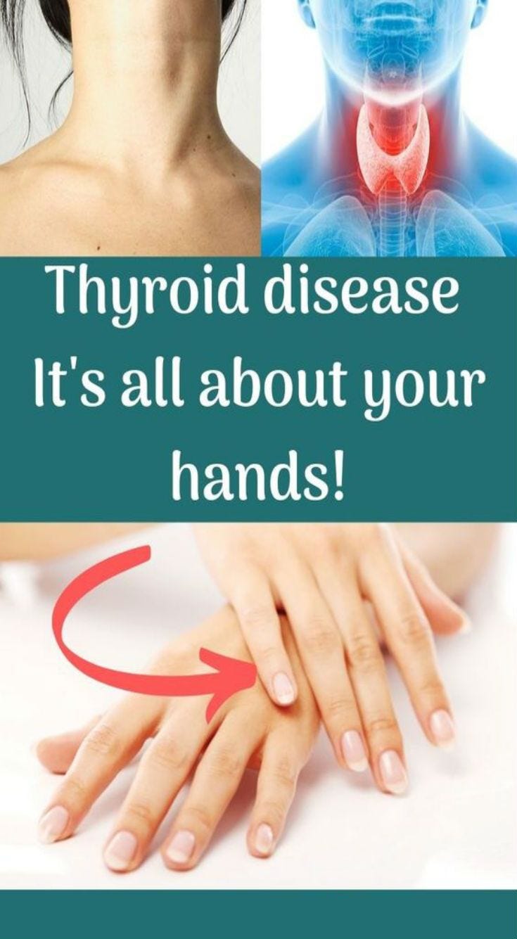 How can you tell if you have hypothyroidism by looking at your hands