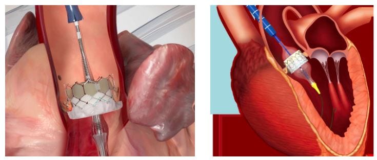 TAVR Surgery: A Minimally Invasive Solution for Aortic Valve Disease