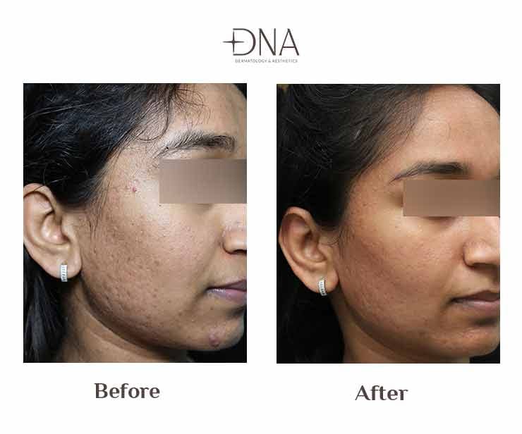 Acne Scar Treatment in Bangalore A Comprehensive Guide to Clearer Skin