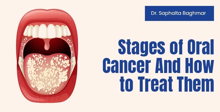 Understanding The Stages Of Oral Cancer A Comprehensive Guide By New Label Medium