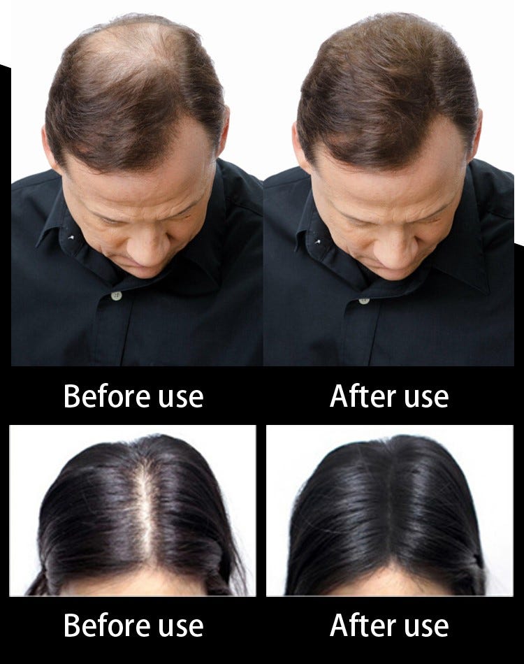 This Guide Will Reveal Everything You Need To Know About Hair Loss ...