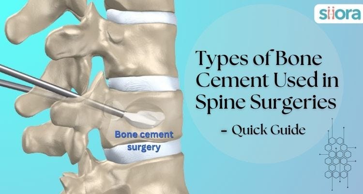 A Quick Guide on the Types of Bone Cement Used in Spine Surgeries ...