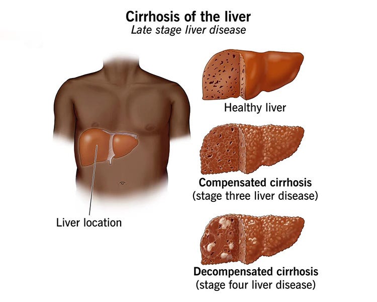 Liver Cirrhosis Treatment In Bhiwandi Dr Chandrakant Medium liver-cirrhosis-treatment-in-bhiwandi-dr-chandrakant-medium