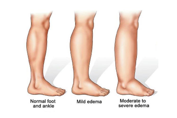 Does Lymphedema need to be treated? by Sante & Physique Medium