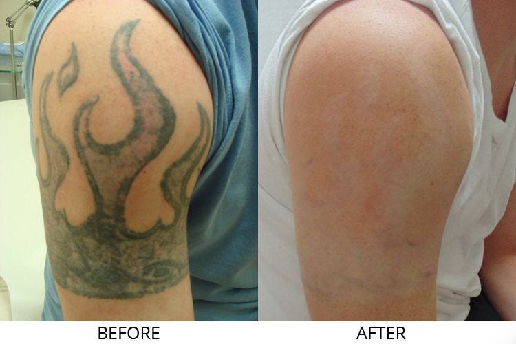 Tattoo Laser Effects tattoo-laser-effects