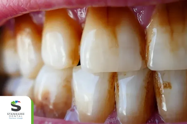 Not All Stains Are the Same