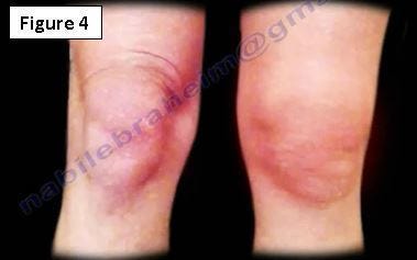 Psoriatic Arthritis. Psoriatic arthritis is a very important by