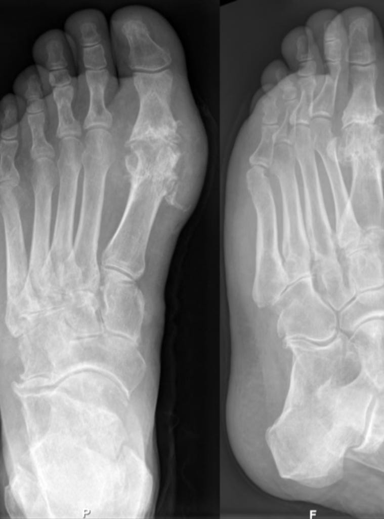 Gout on X-rays of a left foot in the metatarsal-phalangeal joint of the big toe. (Hellerhoff/CC BY-SA 3.0/Wikimedia Commons)