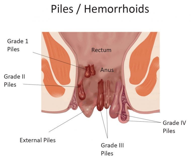 What are the symptoms of piles?. The symptoms of piles (hemorrhoids) can…, by Dr. Chintamani Godbole, Gastrointestinal Surgeon