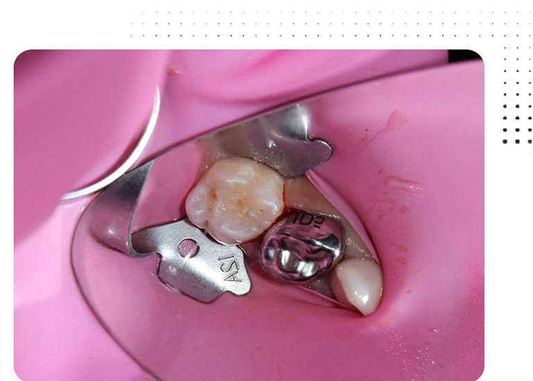 Root Canal Treatment for Children in Pune Best Root Canals Treatment