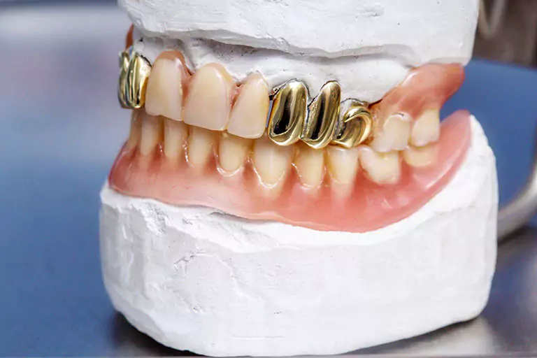 What is a Gold Dental Crown?. A gold dental crown is a treatment that
