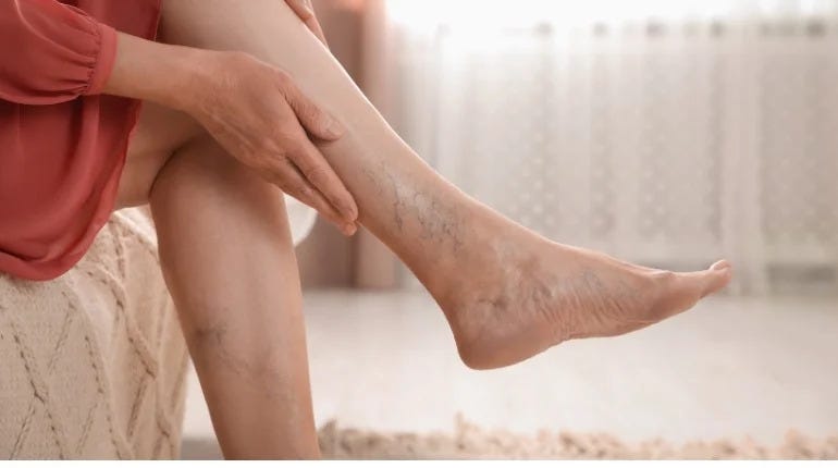 Effective DVT Management with Thrombectomy & Thrombolysis