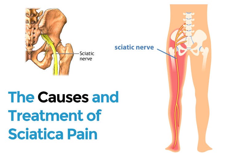 The Causes and Treatment of Sciatica Pain by Sumitz Clinic Medium
