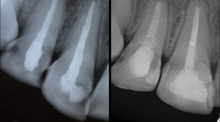 how-painful-is-a-root-canal-without-anesthesia-medium