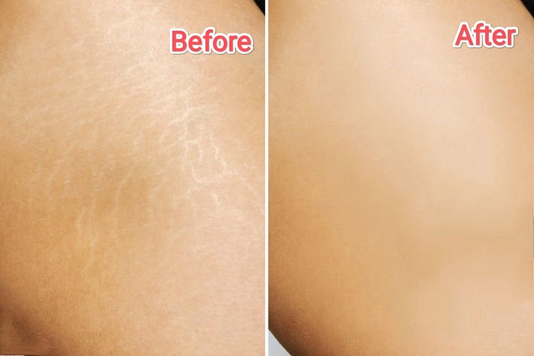 Get rid of stretch marks with our effective therapy in Atlanta, Georgia.