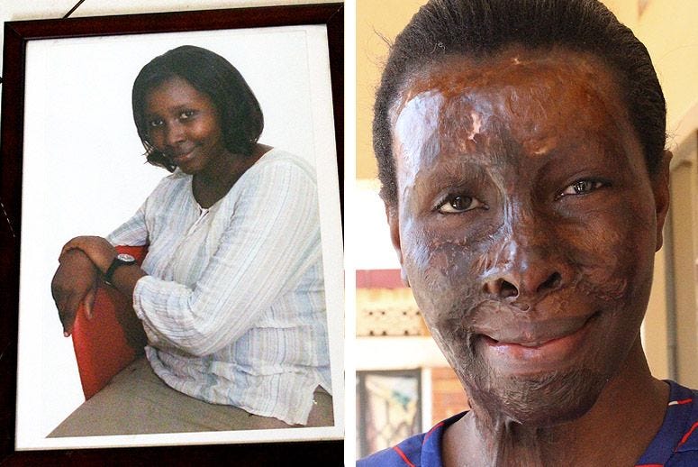 Meet the Inspiring Acid Attack Survivors Who Are Pushing to Change Uganda's  Laws | by TakePart | Medium