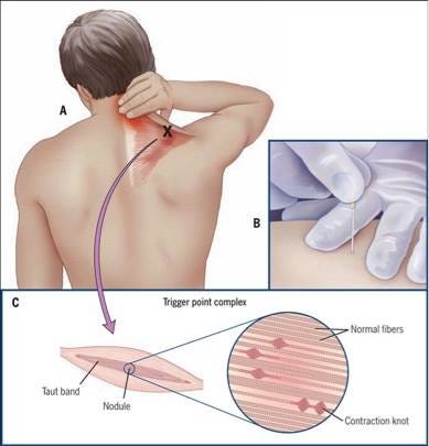 Dry needling VS Acupuncture. Understand the difference between “Dry… | by  Rehab Your Life | Medium