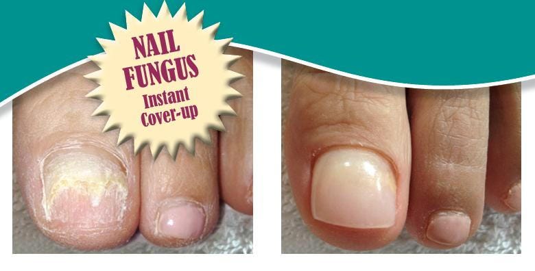 How to Hide Toenail Fungus in the Summer: Quick Tips! | by Sohidul