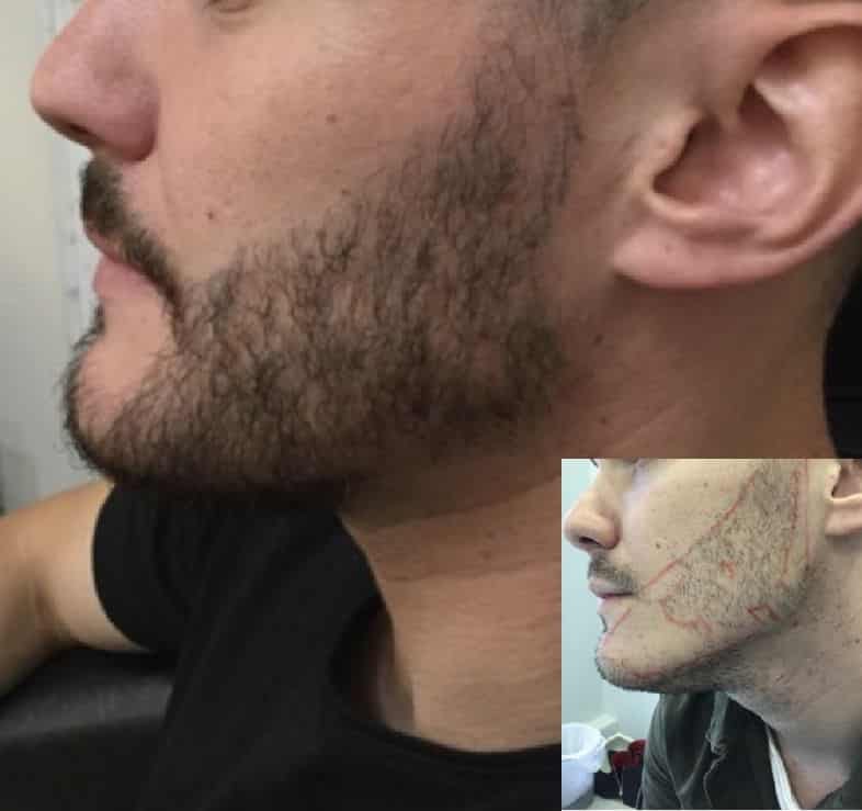 Sideburn Hair Transplant. What is Sideburn Hair Relocate… by