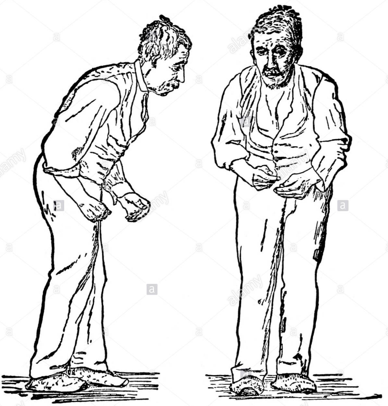 PARKINSON’S DISEASE