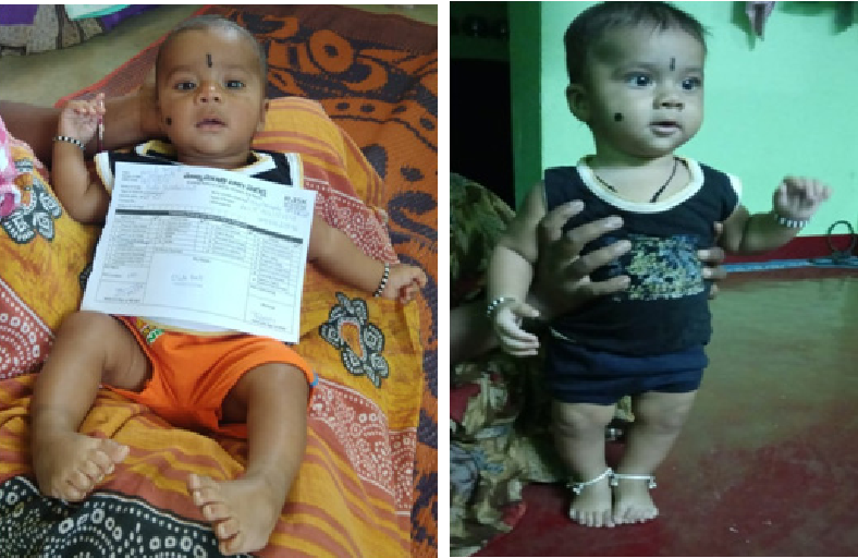understanding-clubfoot-causes-treatment-and-long-term-care-by