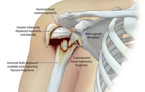 Bone Fractures: Types, Symptoms & Treatment