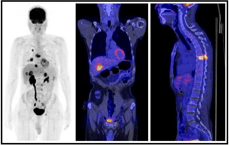 Case Study: 55 years male with Colon Cancer | by Dr. Muayad Mahmud ...