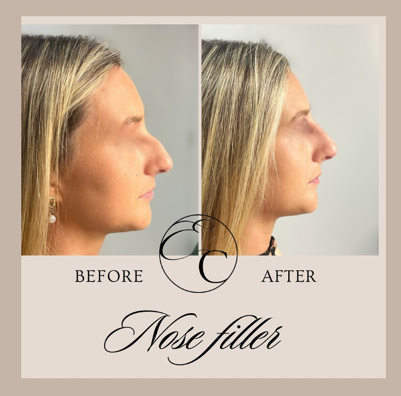Is Nose Correction with Fillers Safe?