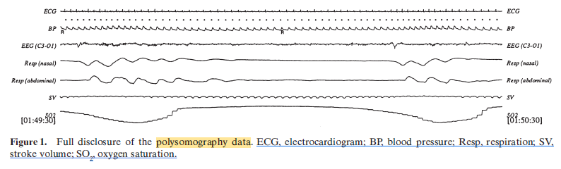 Brief Review — Development of the polysomnographic database on CD-ROM