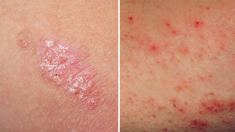 Preview image for How to Distinguish Between Psoriasis and Eczema