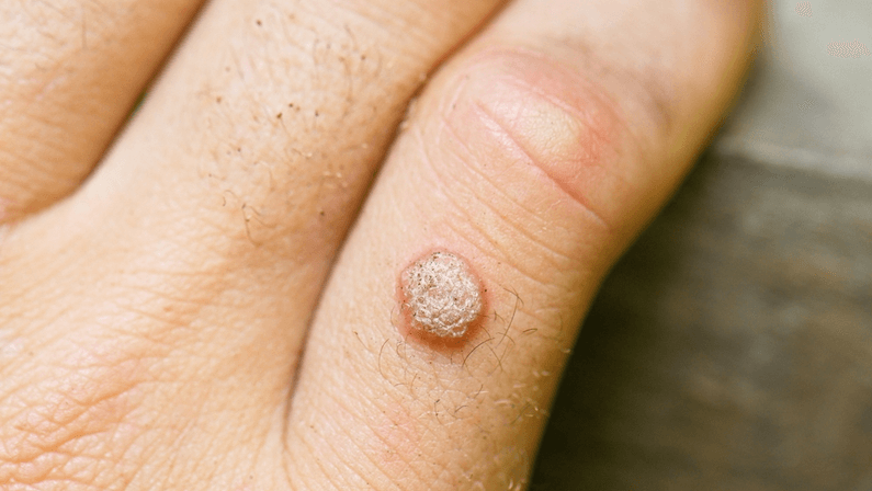 Moles vs Warts: What Your Skin Is Trying to Tell You