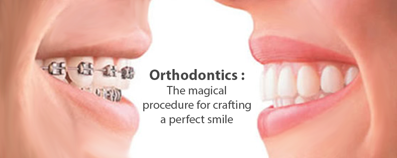 Magical teeth sale brace