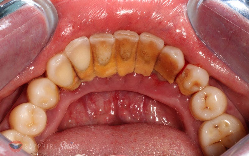 What Is The Procedure For Deep Cleaning Of Teeth? by Richardsgovan