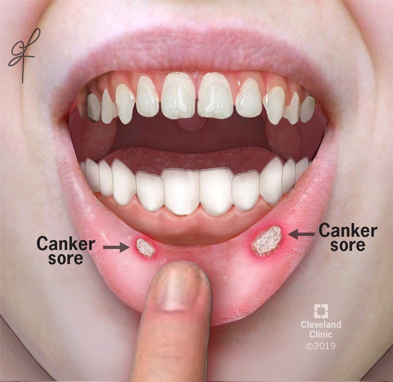 The Unwelcome Guest Understanding and Treating Canker Sores