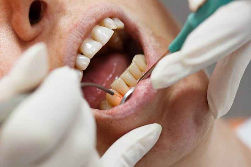What Are The Vital Facts To Know About LANAP Dental Procedure? by